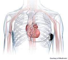 Image result for Internal Cardiac Defibrillator