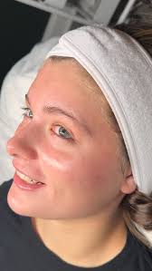 Celebrating one full year of clear, confident skin for my beautiful, sweet  client!!! , She began my acne healing program last year and graduated after  3 months! She has maintained her glow with ...