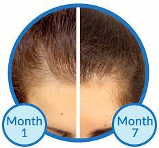There may be more of a connection then you think ★ check under the. Smart Insulin Patch For Diabetics May Help Hair Loss