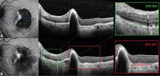 If your retina has detached, you'll need surgery to repair it, preferably within days of a diagnosis. Optical Coherence Tomography Features Of The Repair Tissue Following Rpe Tear And Their Correlation With Visual Outcomes Scientific Reports