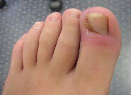 Add epsom salts or a mild soap to the water; Pin On Ingrown Toenails