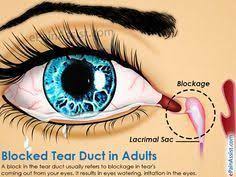 Blocked Tear Duct In Adults Blocked Tear Duct Duct Eye Infection Symptoms