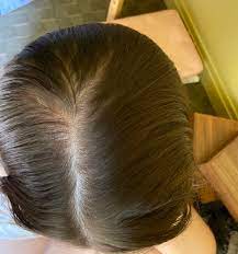 It may be helpful to have someone take pictures of your nape hair and follow over time. My Hair Is Thinning Out So Much I Never Noticed How Bad It Was In The Back Until I Took This Photo I M So Embarrassed And Self Conscious Femalehairloss