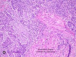 Invasive Urothelial Carcinoma American Urological Association