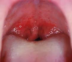 Amigdalitis Que Es Como Se Transmite Diagnostico Mis Pediatras En La Red