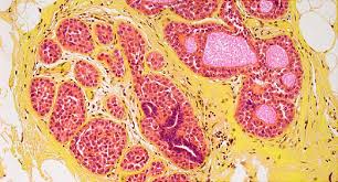 Stage Zero Breast Cancer Signs Symptoms And Causes