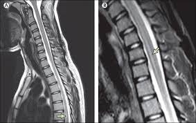 Loss of myelin often leads to spinal cord scarring that blocks nerve impulses and. Acute Myelitis Due To Zika Virus Infection The Lancet