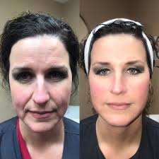 Botox at Be You Medical Spa : Prestonsburg KY : 606-207-8364