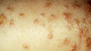 Fungi, like bacteria, love to hang out in the moist folds of skin. 10 Diabetic Skin Problems Everyday Health