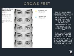 Look at her and if her face is not as alive, then the celebrity has made botox. Top 3 Botox Injection Patterns Markup Skinviva Training