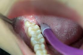 If all four wisdom teeth were removed at the same time, there can be quite a lot of swelling. The Full Time Nsf Guide To Wisdom Tooth Surgery In Singapore