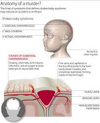 Symptoms Of Shaken Baby Syndrome Doubted By Pathologists Sciencedirect