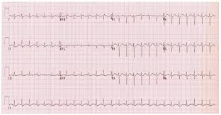 Even before the pandemic, myocarditis was a leading cause of death in young, otherwise healthy. Myocarditis In The Ed Nuem Blog