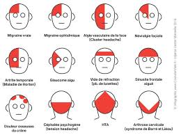 Bienfaits De La Hijama Sur La Migraine Maux De Tete Cephalee De Tension Cephalee Migraine