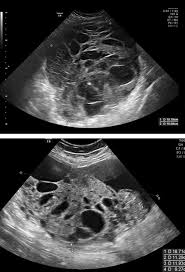 Ovarian cancer develops when cells in the ovaries begin to grow in an uncontrolled fashion. Imaging In Gynecological Disease 17 Ultrasound Features Of Malignant Ovarian Yolk Sac Tumors Endodermal Sinus Tumors Anfelter 2020 Ultrasound In Obstetrics Amp Gynecology Wiley Online Library