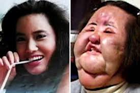 Plastic surgery procedures started as medical treatments but grew into cosmetic surgeries. Plastic Surgery Gone Wrong With Before And After Pictures Wondersify