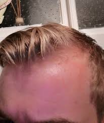 Hair at the top of the head also thins, often progressing to baldness. Thinning On My Right Temple 19 Year Old M Hairloss