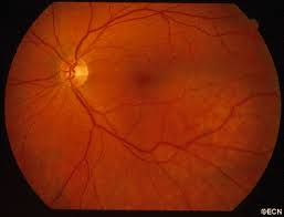 Image result for Choroid