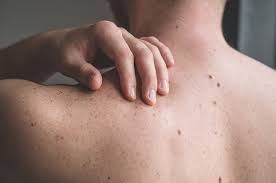 Symptoms may include fever, night sweats, and weight loss. Pigmentation Traits Linked To Risk Of Non Hodgkin Lymphoma Cll Docwire News