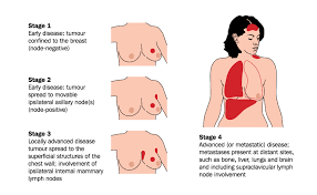 But at the time of diagnosis, most women don't have any apparent signs of breast cancer. Secondary Breast Cancer Poorti A Product Of Aarna Biomedical