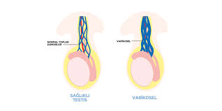 Image result for Varicocele