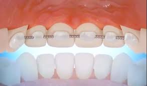Check spelling or type a new query. Orthodontist In Miami Explains Retainer Types