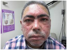 The efficacy of topical metronidazole in the treatment of ocular rosacea. Update On The Management Of Rosacea Ccid