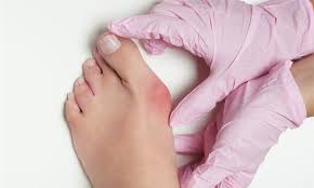 Orang tua, terutama mereka dengan osteoporosis, berada pada risiko yang lebih tinggi. Operasi Bunion Invasif Minimal Health Plus