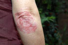 A psoríase é uma doença inflamatória da pele, autoimune, não contagiosa e sem cura. Entenda Agora O Que E Psoriase E Como Tratar Partmed A Maior Rede De Clinicas Medicas Do Brasil