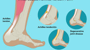 This strain can cause unwanted pain and stress. Achilles Tendon Pain Causes Treatment And When To See A Doctor
