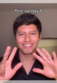 Día 8 postoperatorio de cirugía de estrabismo