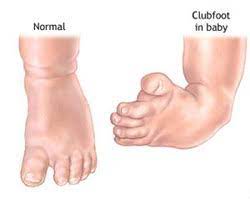 Clubfoot is a word used to describe a foot defect present at birth. Clubfoot Treatment For Kids In Secunderabad Chilakalguda By Kasturi Hospital Id 19515170555