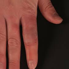 Image result for Erysipeloid