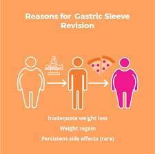 gastric sleeve revision how to get to
