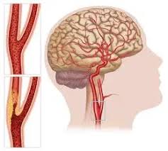Image result for carotid artery