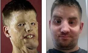 Americano que recebeu transplante de rosto: 'Muito mais fácil sair à rua'