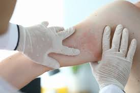 Image result for dermatitis contacta