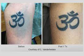 This is important because without all of the laser wavelengths (different colors of laser light) and pulse. Laser Tattoo Removal Utah