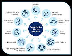 Image result for Allergic Triad