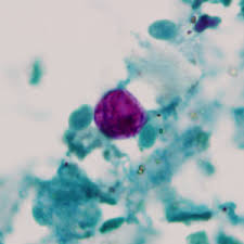 Image result for Cyclospora