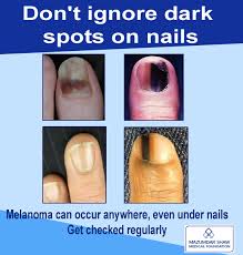 Such bands under the nail are usually benign, but common in women of color. Msmfoundation On Twitter Melanoma Of The Nail Unit Usually Affects Either A Thumb Or Great Toenail But Any Finger Or Toenail May Be Involved May Skincancer Msmf Https T Co Jetbqwtlkz