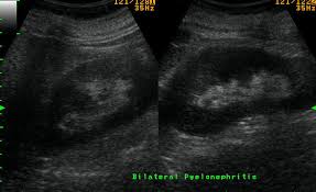 Image result for Acute Pyelonephritis