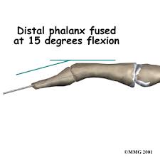 These pins can be removed after two and then four weeks, after which physiotherapy treatment can resume. Physical Therapy In Plymouth For Hand Pain Mallet Finger Injuries