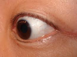 Außerdem bieten kontaktlinsen ein uneingeschränkt scharfes sichtfel während man bei einer brille an den. Kontaktlinse Wikipedia