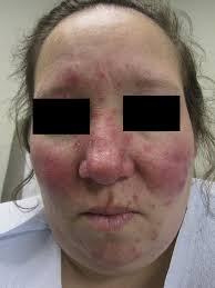 Perioral Lesions and Dermatoses