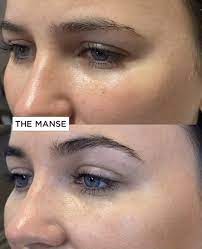 Check spelling or type a new query. Eyebrow Lifting Best Clinic Sydney For Dermal Fillers