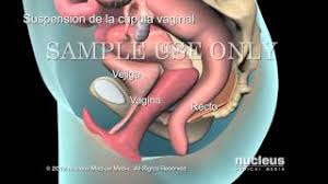 Reparacion De Prolapso Pelvico Youtube