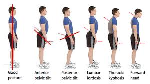 When performing an overhead press, or a core exercise, do you ever notice your rib cage poking out? Pectus Posture Pectus Clinic
