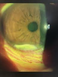 眼科コラム｜大津市堅田（かたた）の「ひの眼科クリニック」｜白内障手術・緑内障