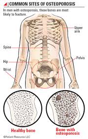 This drug is given as an intravenous (iv) injection, usually either once every 3 or 4 weeks, or once every 12 weeks. Patient Resource Publishing Prostate Cancer Bone Health
